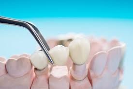 Dental Bridges Treatment