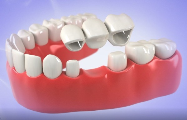 Dental bridges