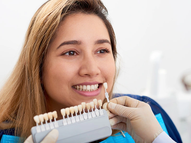 Dental veneers