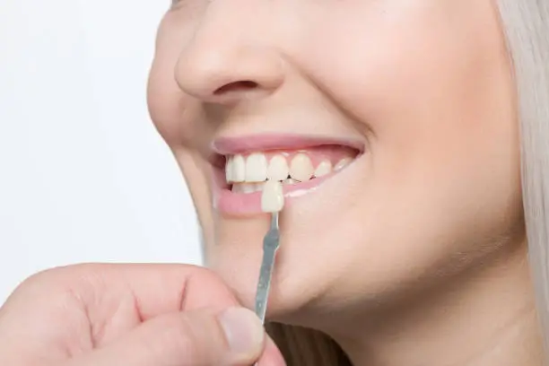 Dental veneer treatment