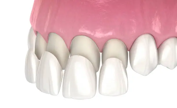 Dental Veneer