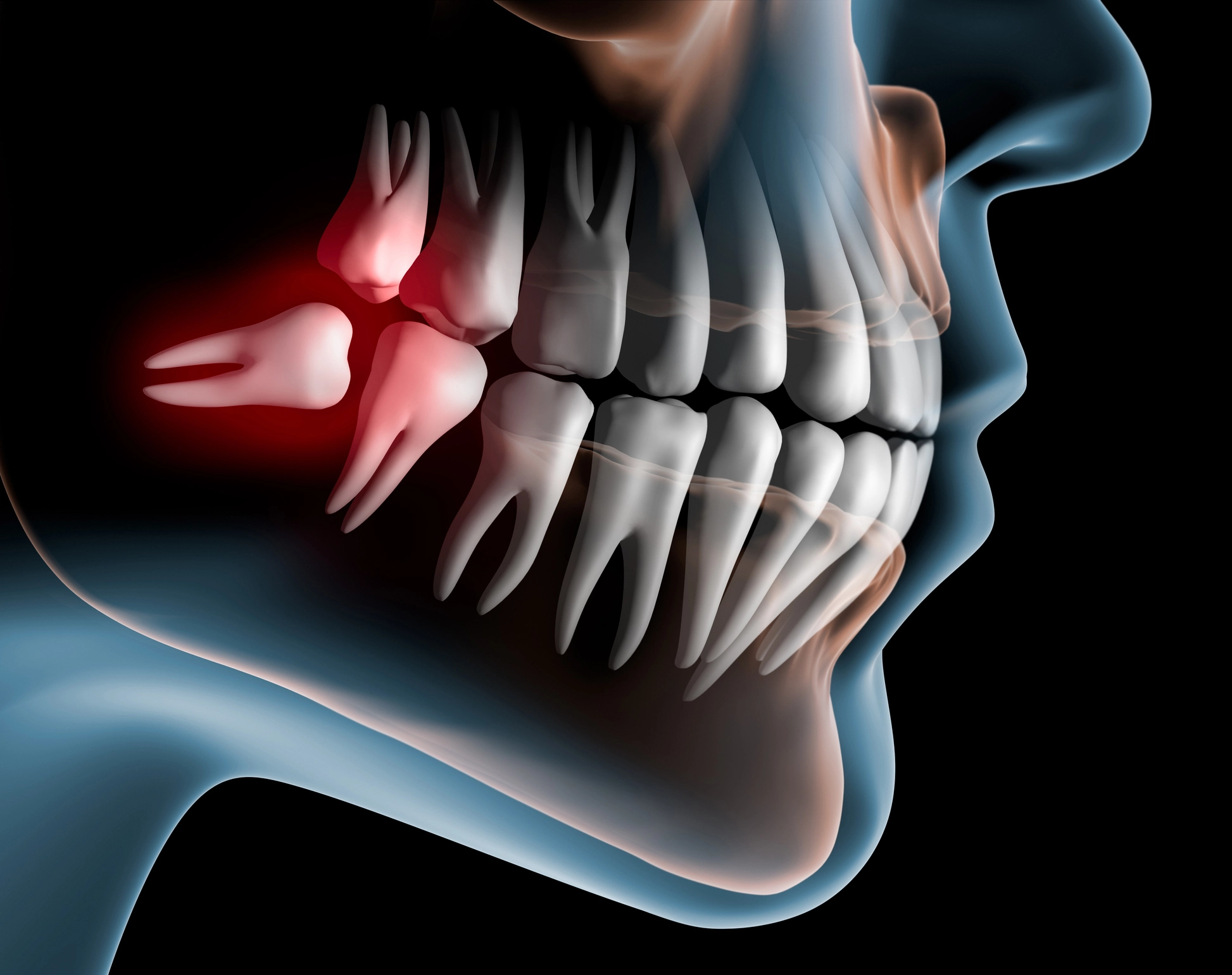 Wisdom teeth