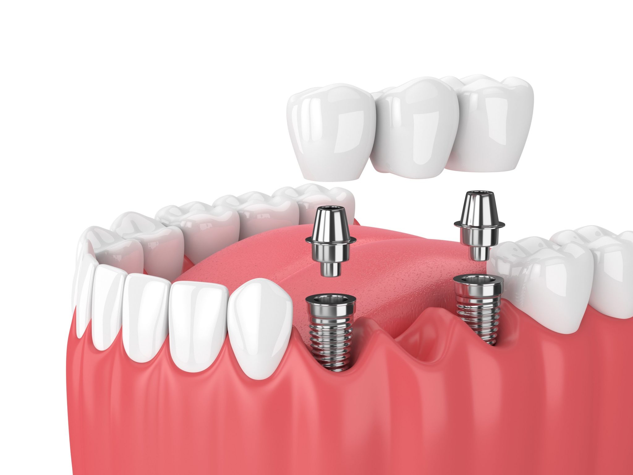 Dental implant process