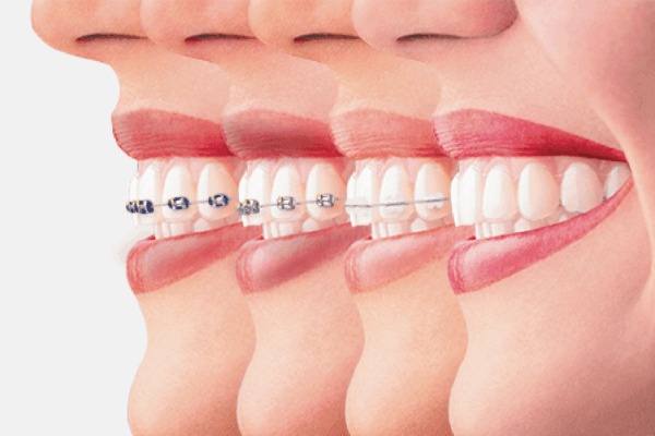 Dental Aligners