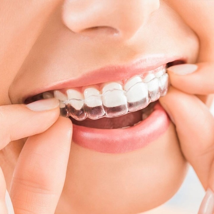 Invisalign Braces
